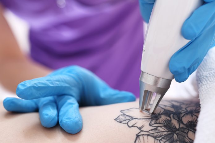 Laserowe usuwanie tatuażu w klinice medycyny estetycznej.