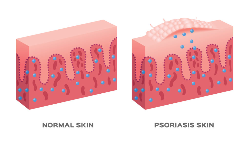 Łuszczyca (łac. Psoriasis)